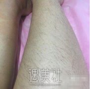 石家庄美联臣做了脱毛，告别昔日的“毛孩子”形象~ width=