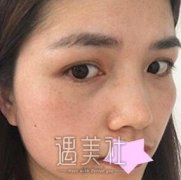 宁波薇琳整形医院做了个祛斑，出门不用戴口罩了 width=