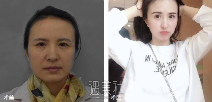 微针除皱