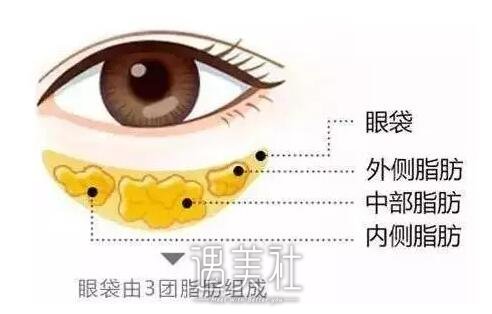 北京超声法去眼袋