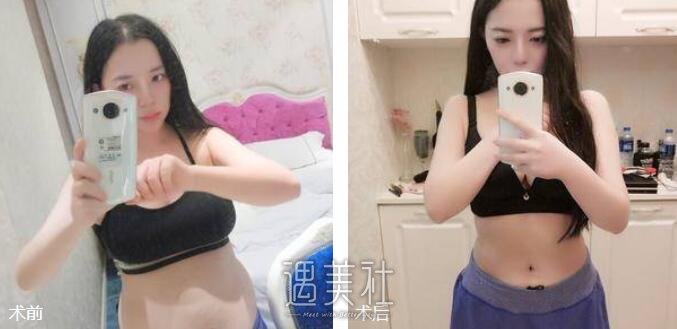 吸脂减肥案例