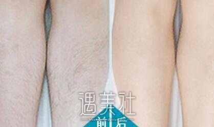宁波,shr脱毛