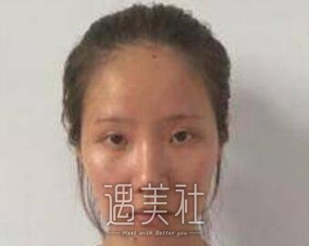 自体脂肪移植,丰脸颊