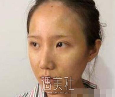 自体脂肪移植,丰脸颊