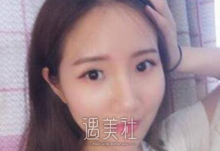 自体脂肪移植,丰脸颊