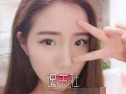 自体脂肪移植,丰脸颊