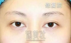 张冰洁医生是做双眼皮专业户？有案例来证明吗？ width=