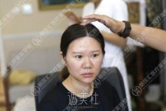 鼻翼缩小对比图片分享——鼻翼缩小真实案例来袭~ width=