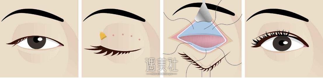 上睑皮肤松弛矫正和切开双眼皮的区别是什么?来看看!