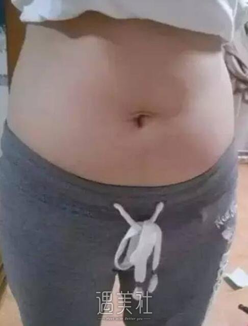 激光溶脂过程全纪录：现在的我很享受别人的羡慕~