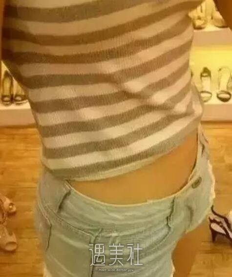 激光溶脂过程全纪录：现在的我很享受别人的羡慕~