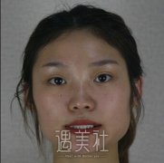 李志海削骨手术对比图片|削骨手术真实案例硬核上线! width=