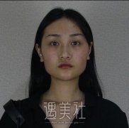 国字脸改脸型价格大约要多少钱?还是喜欢V型小脸啊~ width=