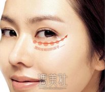 郑州光乳化去眼袋多少钱？比其他方式收费贵吗？ width=