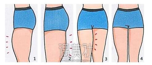 吸脂瘦大腿