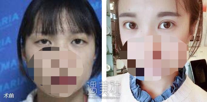 伊美尔双眼皮