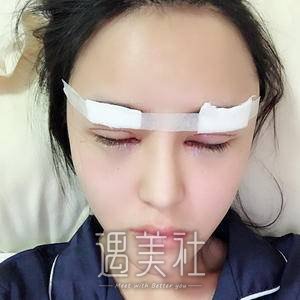 双眼皮修复手术