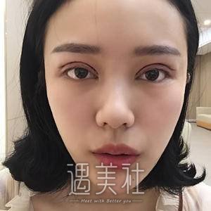 做双眼皮