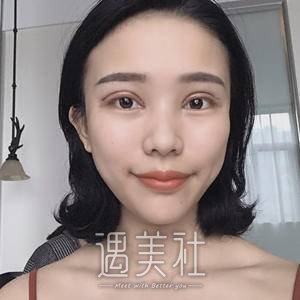 做双眼皮