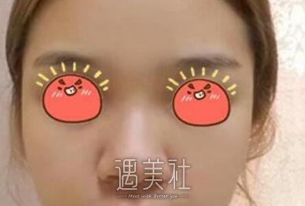 蒜头鼻整形