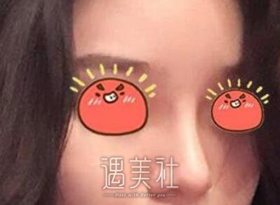 蒜头鼻整形