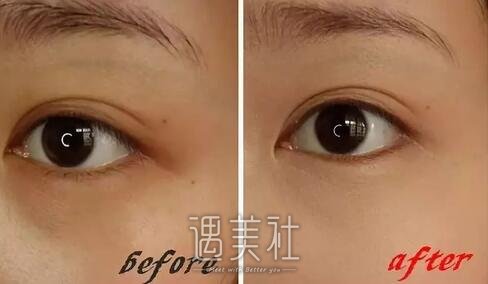 九院,去眼袋