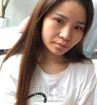 鼻中隔隆鼻