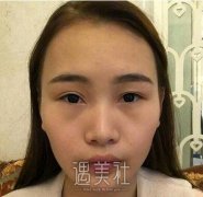 福州武警整形医院打了注射瘦脸，整个脸都精致了许多！ width=