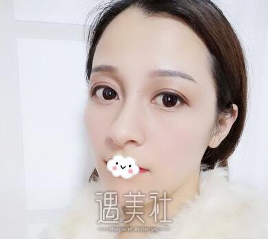 广州,海峡整形,割双眼皮