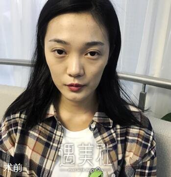 煤炭总医院,艾红梅,脂肪填充