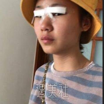 煤炭总医院,梁伟中,双眼皮