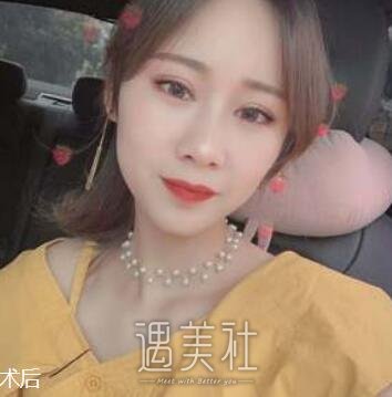 煤炭总医院,梁伟中,双眼皮