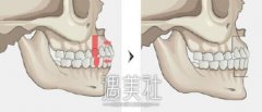 韩国双颚手术费用多少钱?会比国内做便宜还是贵呢? width=