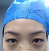 长春铭医整形价格表，附吉林铭医双眼皮案例一则～ width=