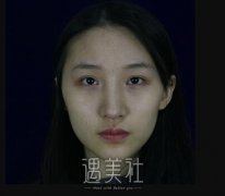 俞良钢做颧骨手术一般多少钱?我想这篇日记里有答案～ width=