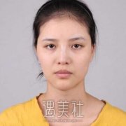 去广州曙光找蒋思军做了歪鼻矫正，鼻梁终于不再S型啦~ width=