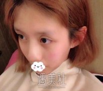 广州曙光蒋思军做鼻子怎么样？我在网上看到这篇案例 width=