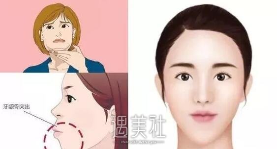 双鄂手术
