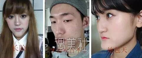 双鄂手术