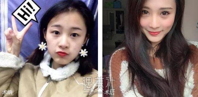 埋线双眼皮果图