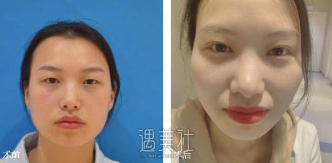 埋线双眼皮果图
