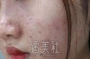 激光调节痤疮