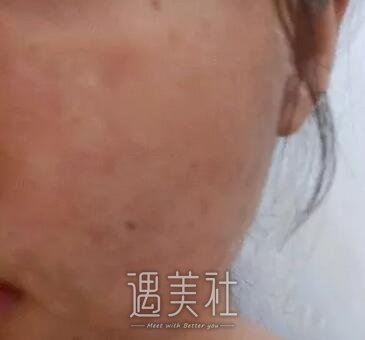 激光调节痤疮