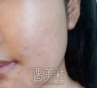 激光调节痤疮