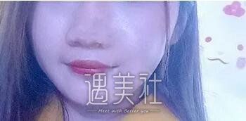 激光调节痤疮