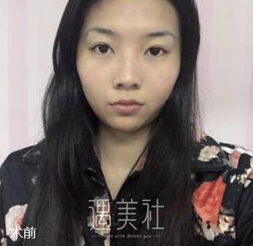 广州,曙光,王旭明,做鼻子