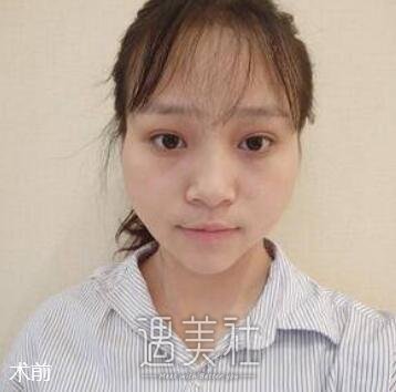 面部填充术