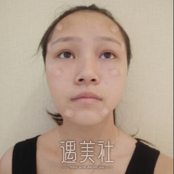 面部填充术
