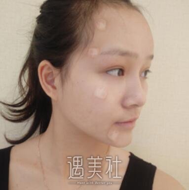 面部填充术