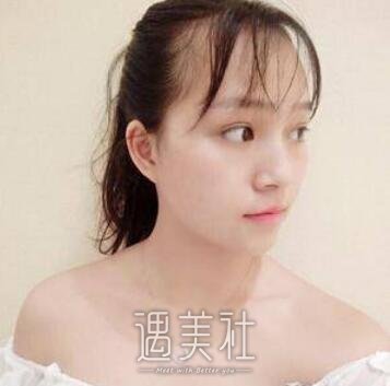 面部填充术